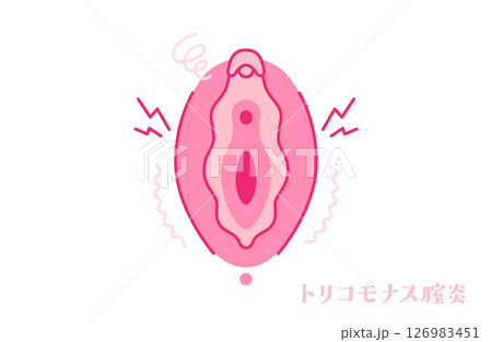 トリコモナス膣炎のある女性器(外陰部) トリコモナス膣炎のある女性器(外陰部) 126983451