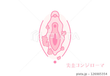 尖圭コンジローマのある女性器（外陰部） 126985354