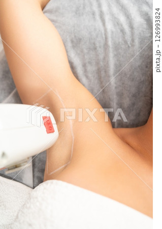 Close-up of laser hair removal underarms. 126993824
