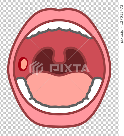 Mouth ulcers Mouth ulcers 127013472