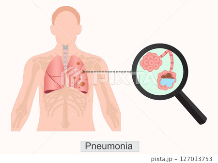 Pneumonia is a lung infection where the air sacs (alveoli). 127013753