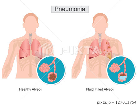 Pneumonia is inflammation and fluid in lungs. 127013754