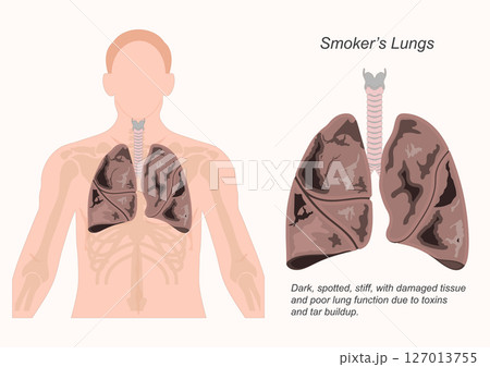 Smokers lungs are often gray or black. 127013755