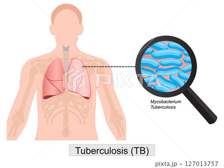 Tuberculosis is a bacterial disease that usually affects the lungs. 127013757