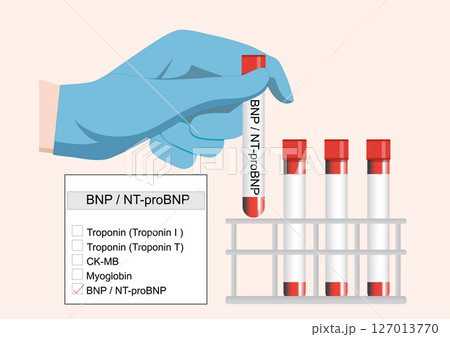 BNP and NT-proBNP are useful markers for diagnosing and monitoring heart failure. 127013770