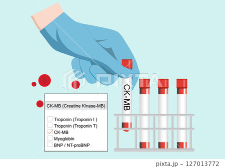 CK MB levels can help identify a reinfarction shortly after the first heart attack. 127013772