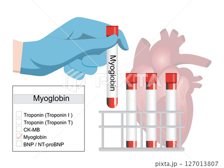 A myoglobin test is a quick. A myoglobin test is a quick. 127013807