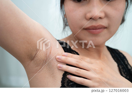 Asian woman have problem black armpit beauty skin care. 127016003