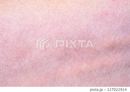 dry and dehydrated human skin texture background 127022914