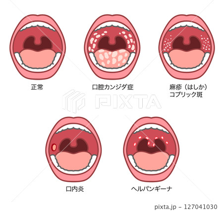 口腔内にできる症状のイラストセット 127041030