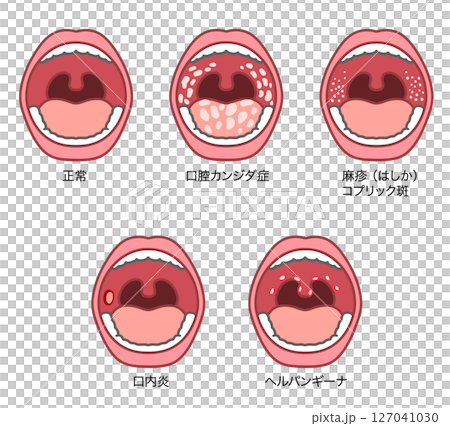 Illustration set of symptoms in the oral cavity 127041030