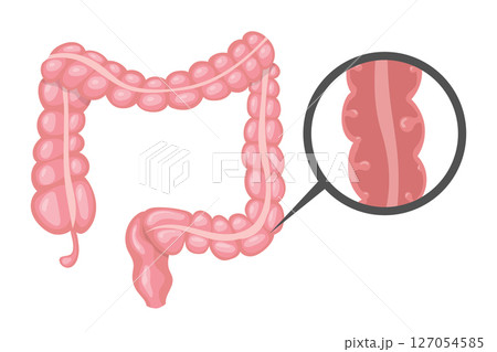 Intestinal polyps forming inside large intestine forming a tumor Intestinal polyps forming inside large intestine forming a tumor 127054585