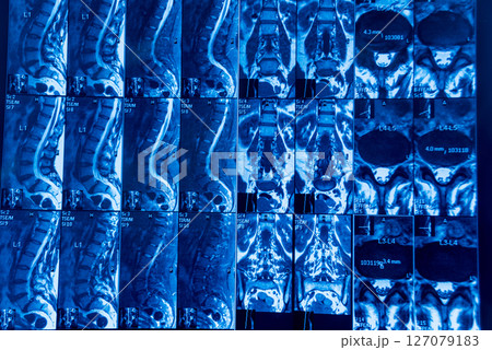 MRI scan of spine a patient with chronic back pain. 127079183