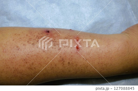 虫刺されによる傷跡 虫刺されによる傷跡 127088845