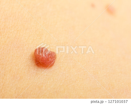 Closeup brown mole on caucasian woman skin. Closeup brown mole on caucasian woman skin. 127101037