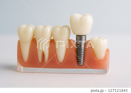 歯のインプラントの治療をしている様子 127121845