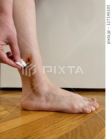 Close-up photo of healing post-surgical scar on the right ankle with of iodine solution applied with a cotton swab. Concept of wound care, disinfection, and recovery after surgery. Close-up photo of healing post-surgical scar on the right ankle with of iodine solution applied with a cotton swab. Concept of wound care, disinfection, and recovery after surgery. 127140105