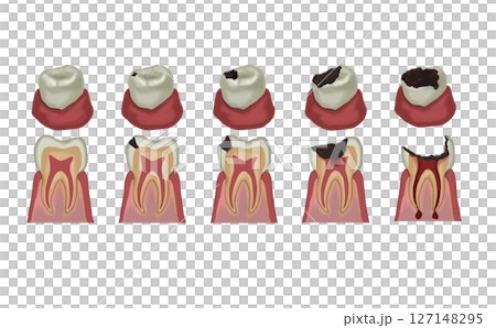 蛀牙階段的圖示 蛀牙階段的圖示 127148295