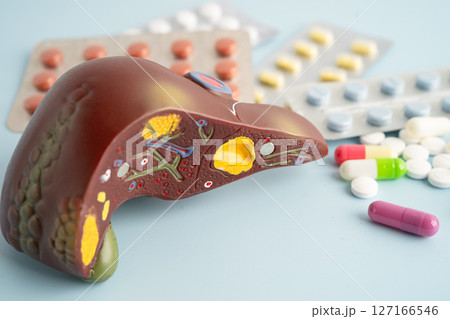 Liver model with pill drug treatment, Cirrhosis, Liver cancer, fatty liver. Liver model with pill drug treatment, Cirrhosis, Liver cancer, fatty liver. 127166546