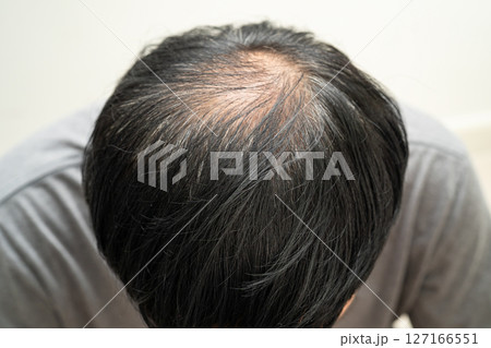 Bald in the middle head and begin no loss hair glabrous of mature Asian business smart active office man. Bald in the middle head and begin no loss hair glabrous of mature Asian business smart active office man. 127166551
