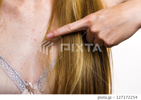 Woman with skin problem acne on neckline 127172254