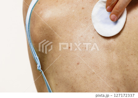 Woman acne on back cleaning skin with cotton 127172337