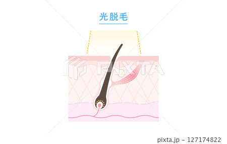 光脱毛・エステ脱毛のしくみ断面図 127174822