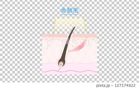 Cross-sectional diagram of the mechanism of laser hair removal and beauty salon hair removal Cross-sectional diagram of the mechanism of laser hair removal and beauty salon hair removal 127174822