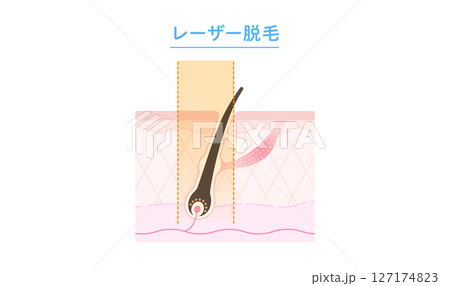 レーザー脱毛・医療脱毛のしくみ 断面図 レーザー脱毛・医療脱毛のしくみ 断面図 127174823
