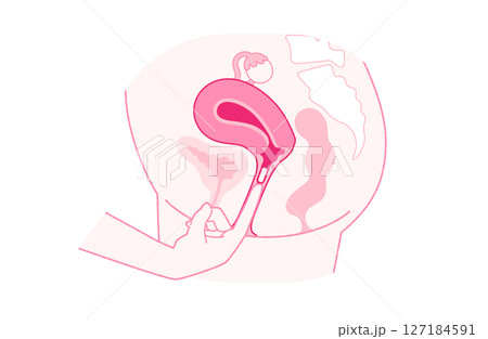 膣錠の正しい挿入イメージ 膣錠の正しい挿入イメージ 127184591