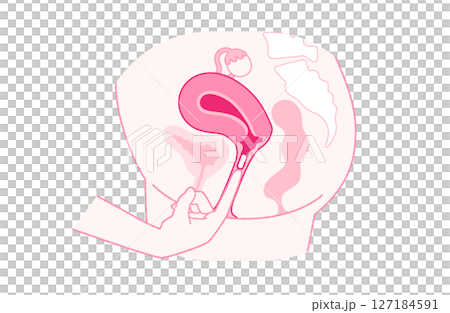 膣錠の正しい挿入イメージ 膣錠の正しい挿入イメージ 127184591