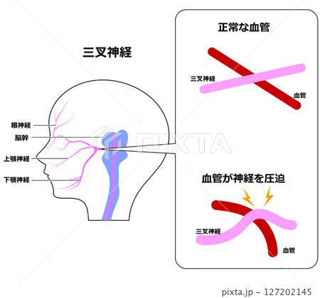 三叉神経痛のしくみ 三叉神経痛のしくみ 127202145