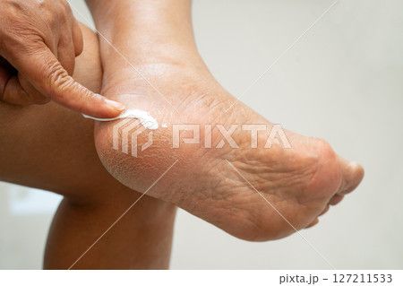 Asian woman applying moisturizing cream skincare treatment to solve and repair feet with crack and dry heel skin. Asian woman applying moisturizing cream skincare treatment to solve and repair feet with crack and dry heel skin. 127211533