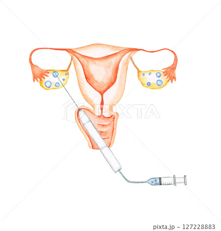 不妊治療 妊活　子宮 体外受精 採卵 　水彩 イラスト 127228883