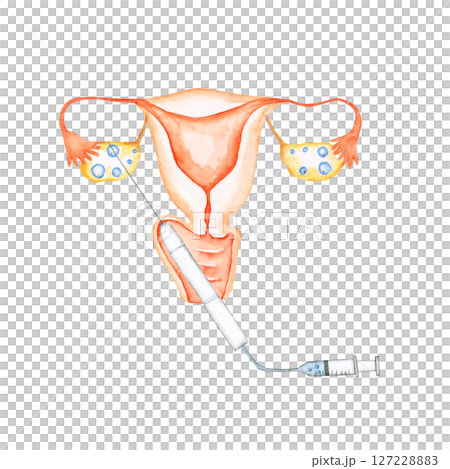不妊治療 妊活　子宮 体外受精 採卵 　水彩 イラスト 127228883