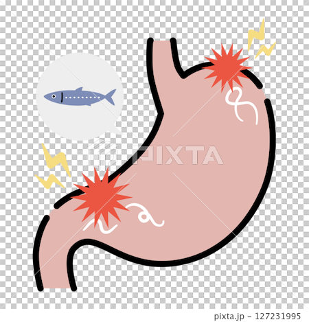Stomach infected with Anisakis 127231995