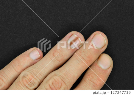 Finger with melanonychia Finger with melanonychia 127247739