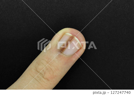 Finger nail with melanonychia Finger nail with melanonychia 127247740