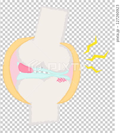 Hand-drawn illustration of joints and bones: Osteoarthritis of the knee 127260923