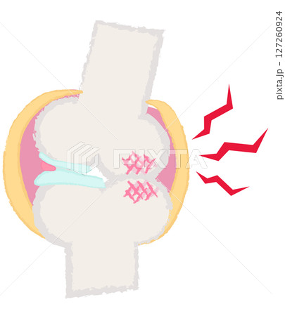 手描きの関節・骨のイラスト 変形性膝関節症 手描きの関節・骨のイラスト 変形性膝関節症 127260924