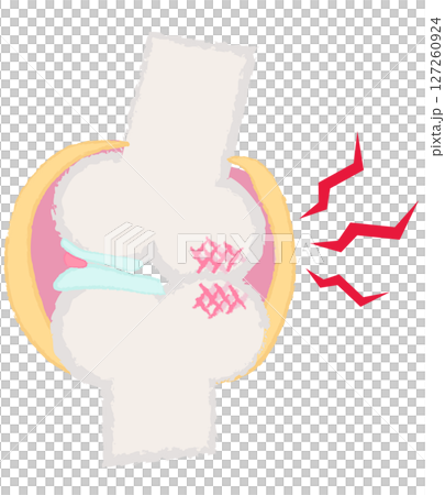 手描きの関節・骨のイラスト 変形性膝関節症 手描きの関節・骨のイラスト 変形性膝関節症 127260924