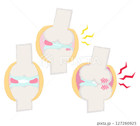 手描きの関節・骨のイラスト　変形性膝関節症 127260925