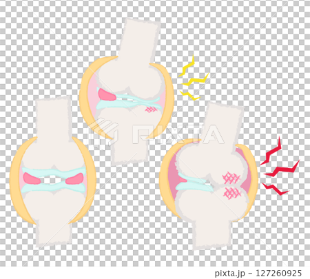 手描きの関節・骨のイラスト　変形性膝関節症 127260925