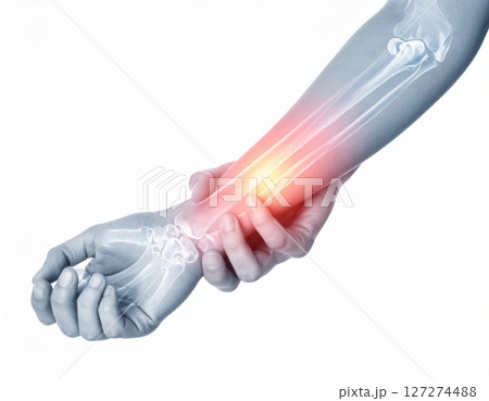 Arm pain radiating in the close area, illustrated as shining spot in half transparent arm, over white background Arm pain radiating in the close area, illustrated as shining spot in half transparent arm, over white background 127274488