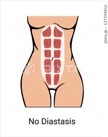 No Diastasis in a woman before and after pregnancy. The anatomy of a Woman. Woman muscular corset, body part. Vector illustration 127349812