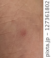 肌　皮膚　虫刺され　症状　クローズアップ 127361802