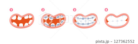 Braces teeth steps from diastema teeth to healthy teeth illustration vector design on white background. Dental care concept. 127362552