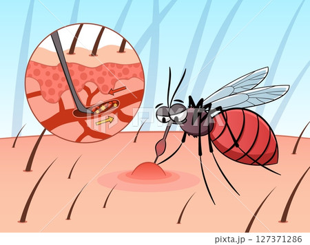 Mosquito drinks blood. Parasitic insect, cartoon character, sucking blood pest, skin surface with capillaries, scheme. Bloodsucker wound. Painful skin bite, malaria tidy vector concept Mosquito drinks blood. Parasitic insect, cartoon character, sucking blood pest, skin surface with capillaries, scheme. Bloodsucker wound. Painful skin bite, malaria tidy vector concept 127371286