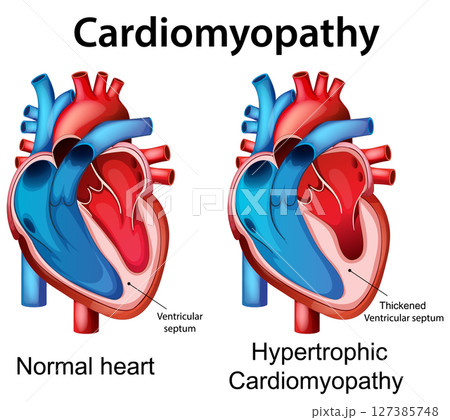Comparison of Normal and Hypertrophic Cardiomyopathy Hearts 127385748