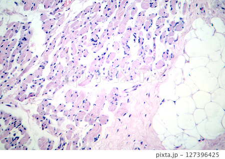 Skeletal muscle atrophy, photomicrograph showing decreased fiber size with increased spacing between them, reduced myofibrils, increased endomysial connective tissue with fatty infiltration 127396425